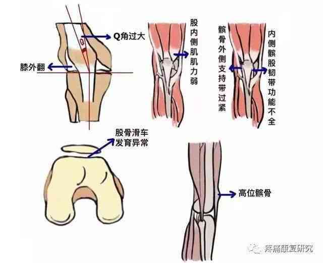 复发性髌骨脱位认定工伤吗