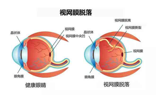外伤视网膜脱落评几级残：外伤性视网膜脱落伤残等级及自愈可能性分析