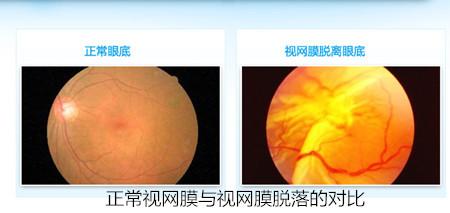 外伤性视网膜脱落认定工伤