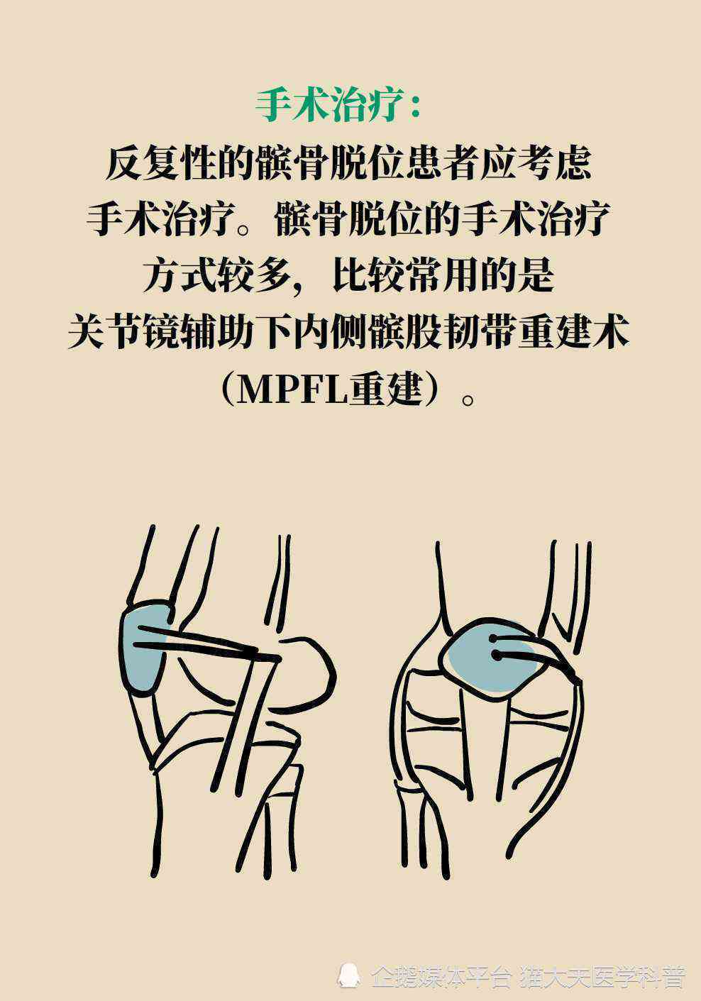 ai运动完腿疼文案