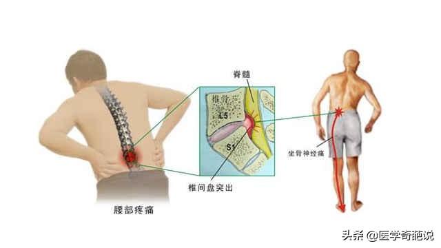 外力可以导致颈椎病吗：原因、治疗及对颈椎突出的影响与退行性变