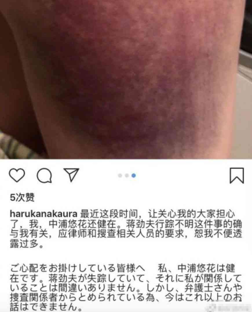 多处挫伤可以要求赔偿吗——赔偿金额如何计算及索赔流程介绍