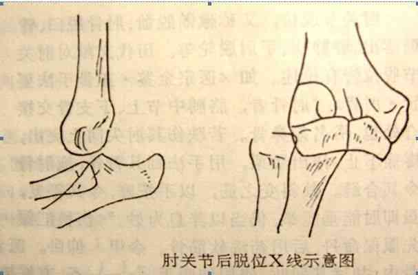 大关节脱位可以认定工伤吗
