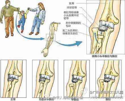 大关节脱臼可以认定工伤吗