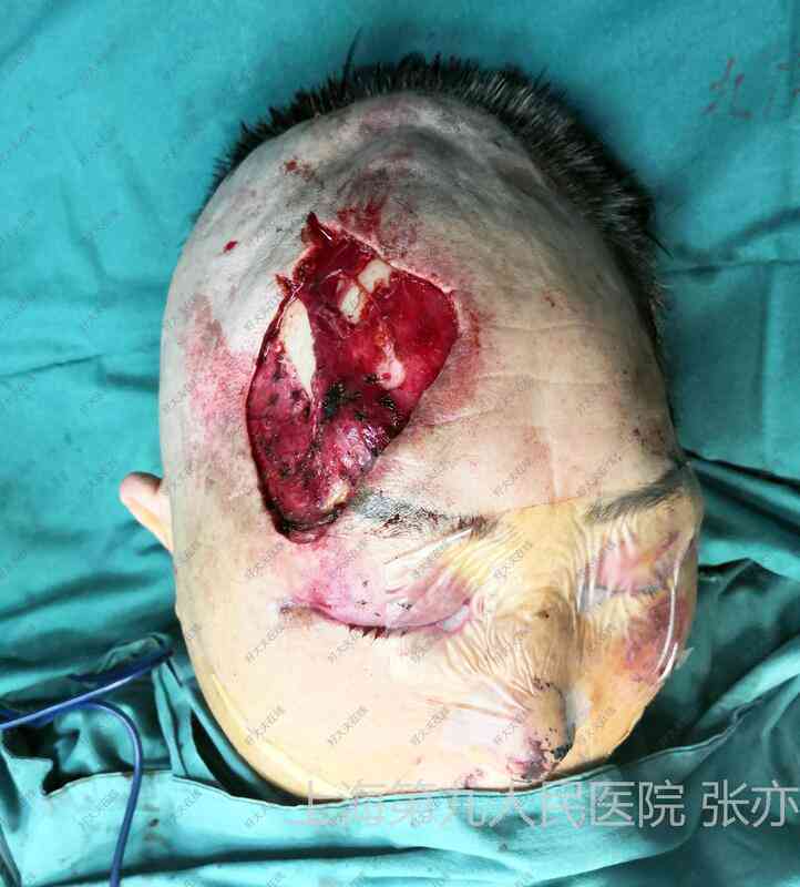 头皮撕裂伤是否构成轻伤级别：法律医学角度解析
