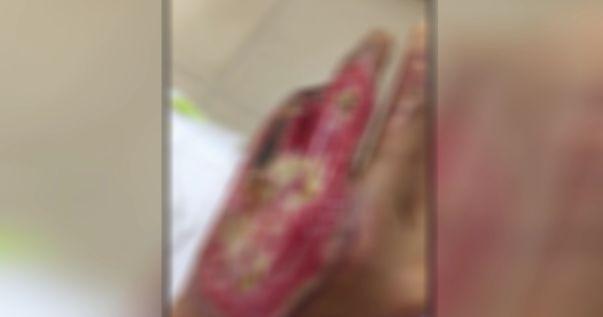 如果手指断了能认定工伤吗：工伤认定及赔偿标准与伤残等级划分