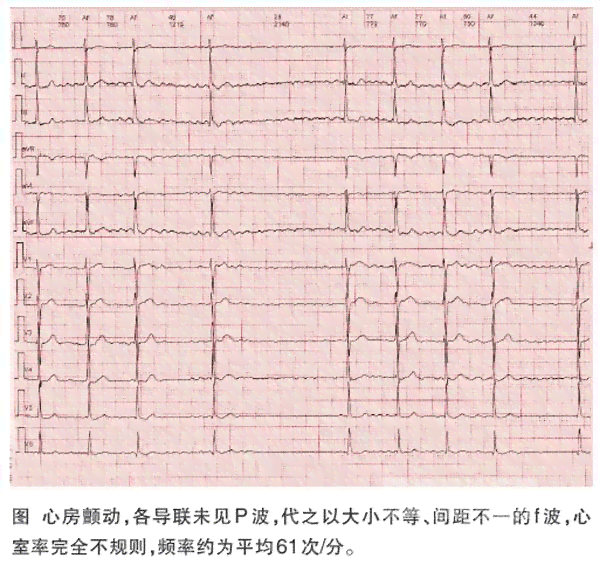 频发室性早搏患者入职体检合格指南与应对策略
