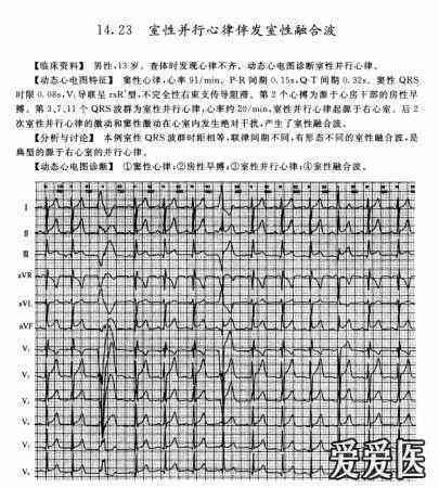 室性早搏可以认定工伤吗
