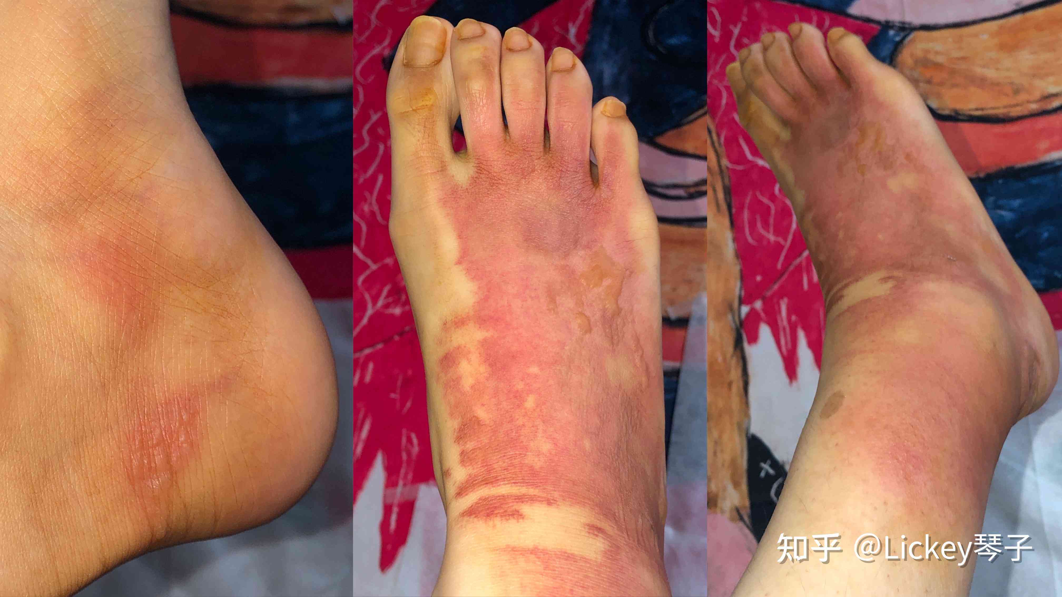 轻微烫伤是否遗留疤痕：了解烫伤程度与疤痕形成的关系