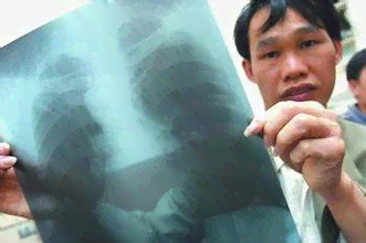尘肺病工伤认定及赔偿权益解析：如何确定尘肺病是否属于工伤事故