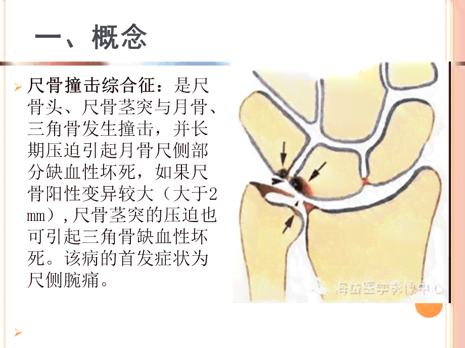 尺骨撞击综合症能定伤残吗：工伤认定、治疗难度、确诊方法与复锻炼