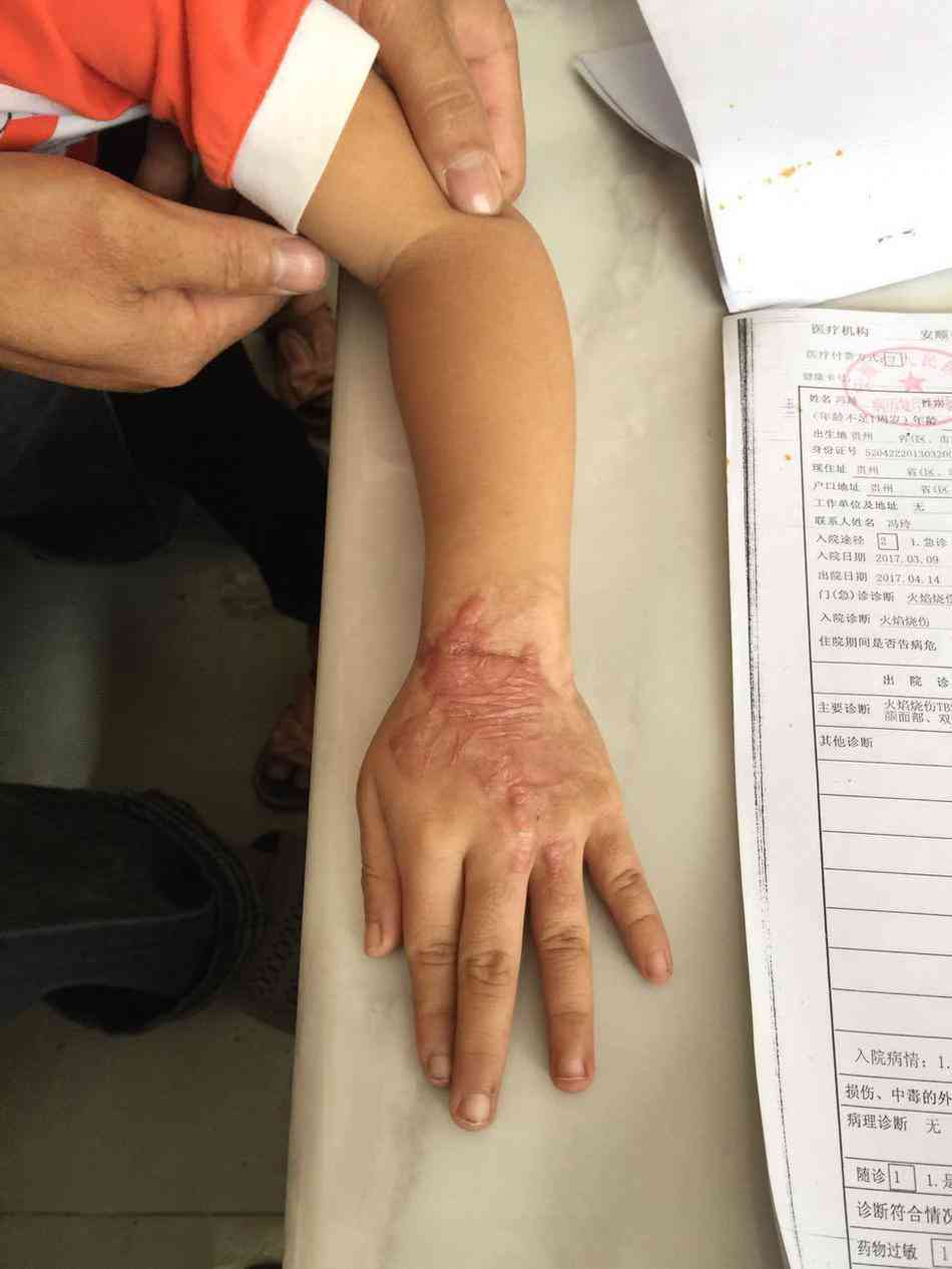 工作时被烫伤认定工伤的标准及条件详解
