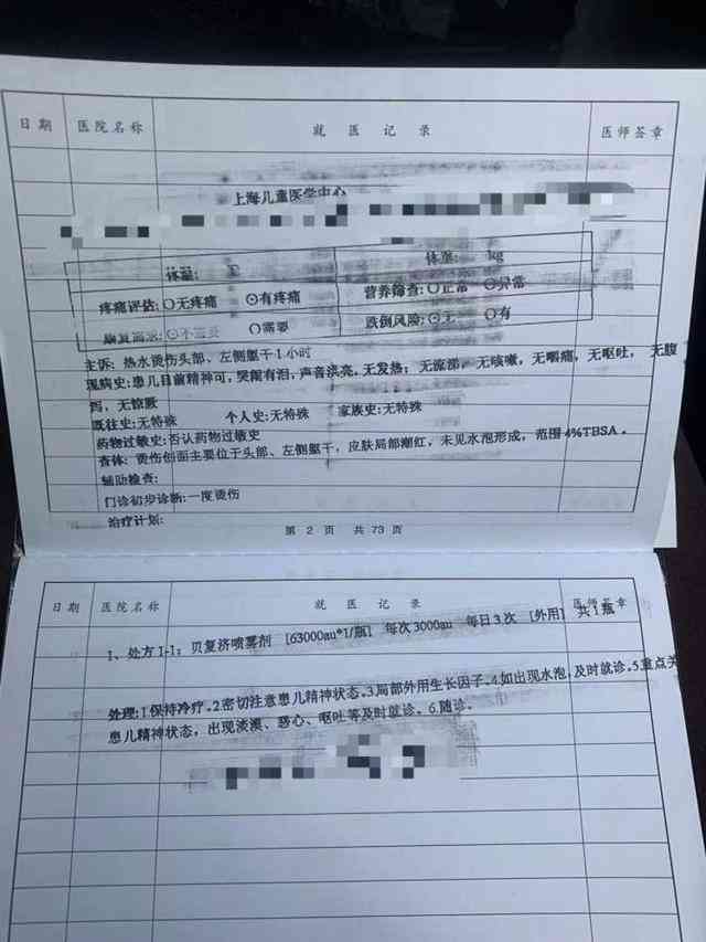 工作时被烫伤认定工伤的标准及条件详解