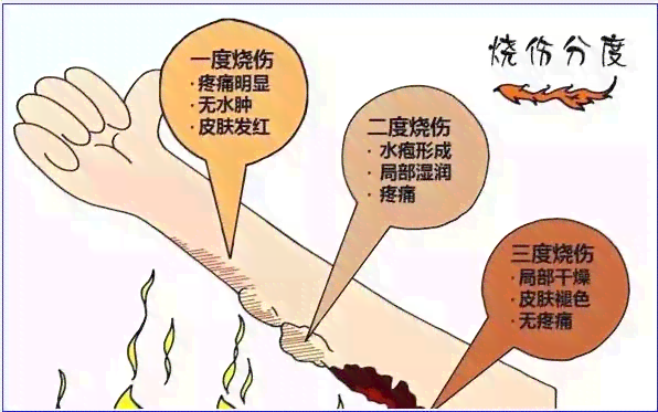 职业烫伤事故赔偿细则及标准解读