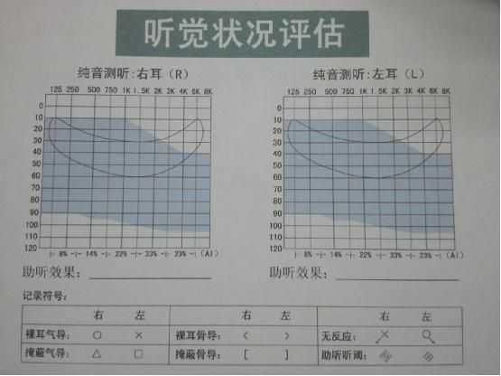 正常的电测听报告单：填写方法、结果计算及样本示例