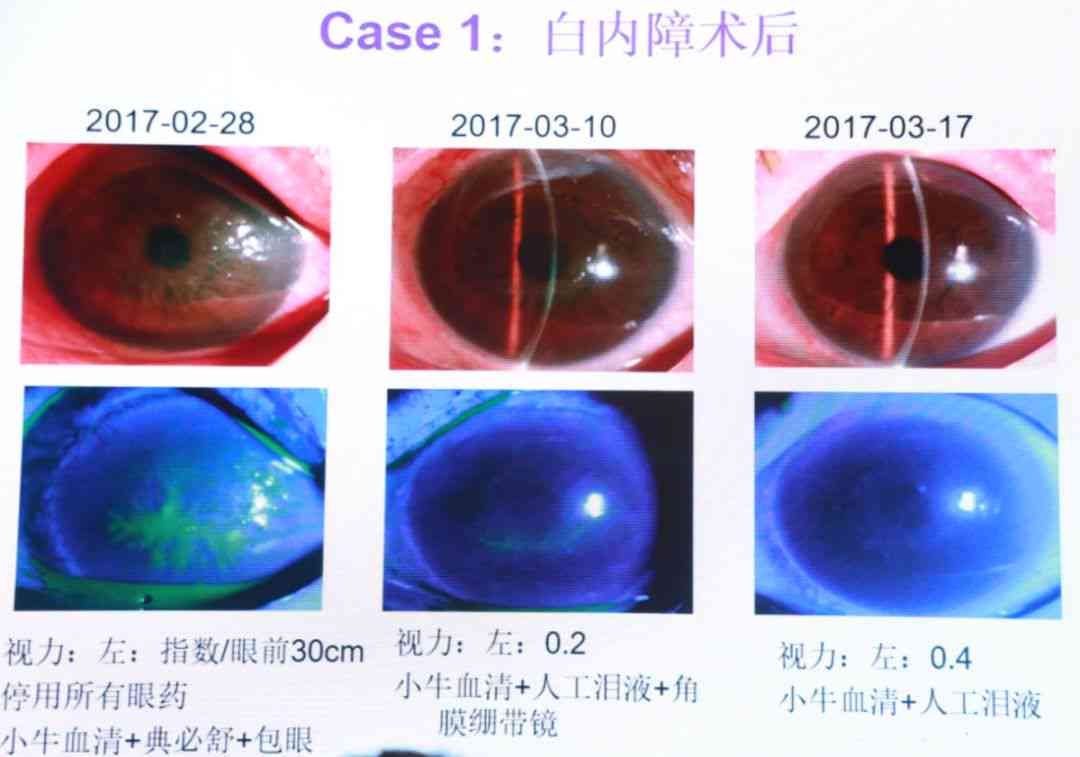 专家解析：角膜上皮脱落损伤程度及处理方法，告别模糊视界