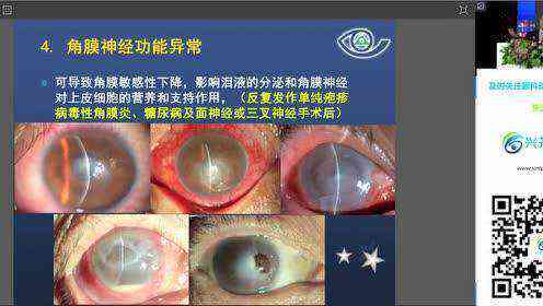 角膜上皮缺损：治疗方式、严重性评估及损伤含义解析