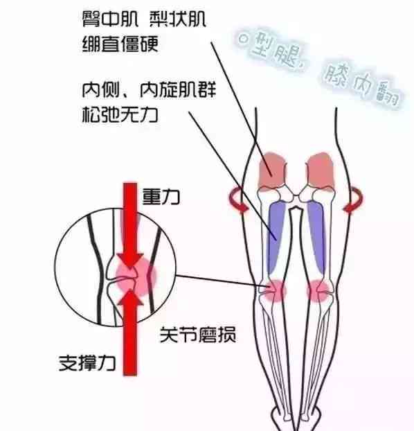 '踝骨扭伤后恢复行走的时间指南：复周期解析'