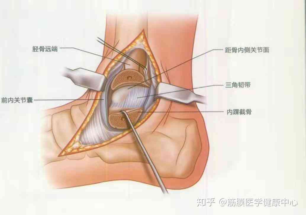 踝关节扭伤：症状、原因、诊断、治疗与复指南