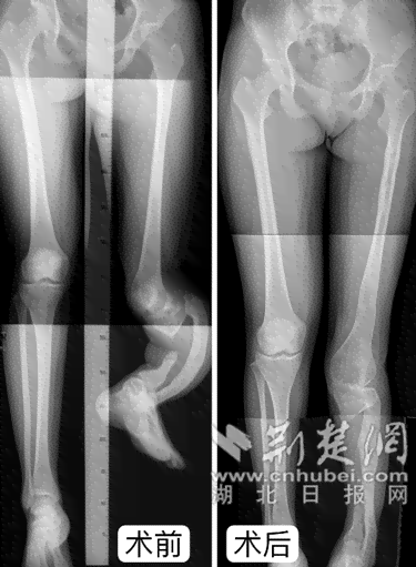 '踝骨扭伤后恢复行走的时间指南：复周期解析'