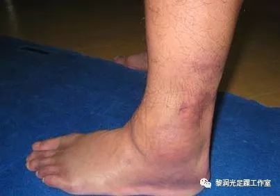 踝关节扭伤：症状、原因、诊断、治疗与复指南