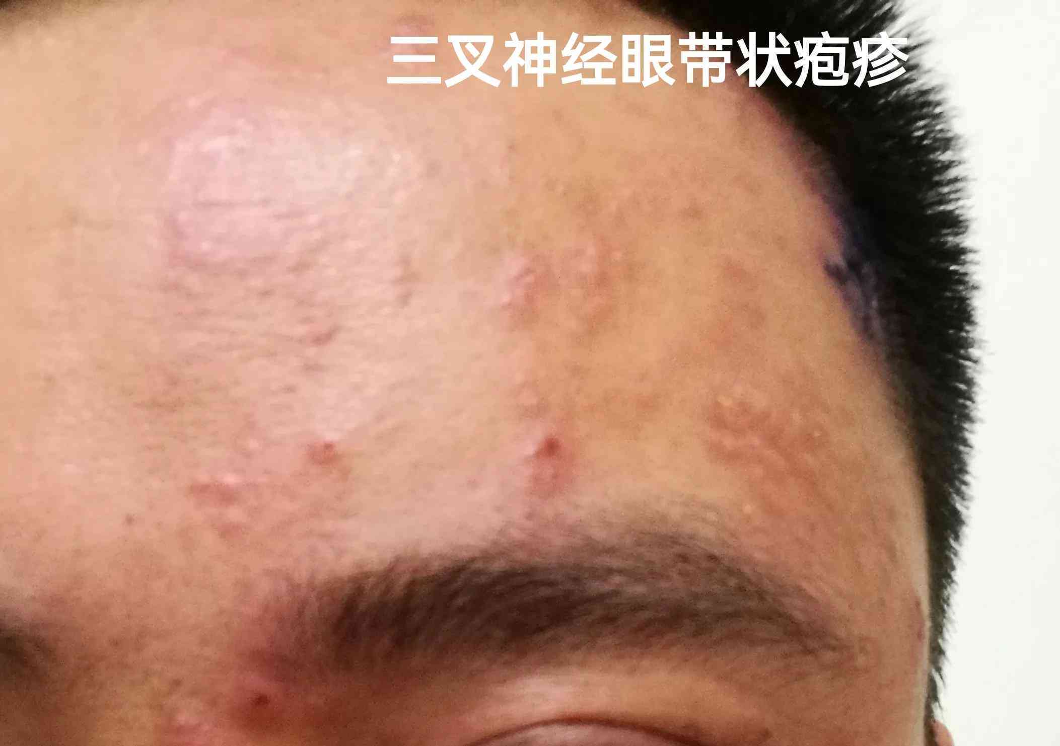带状疱疹对职场表现及工作效率的潜在影响解析