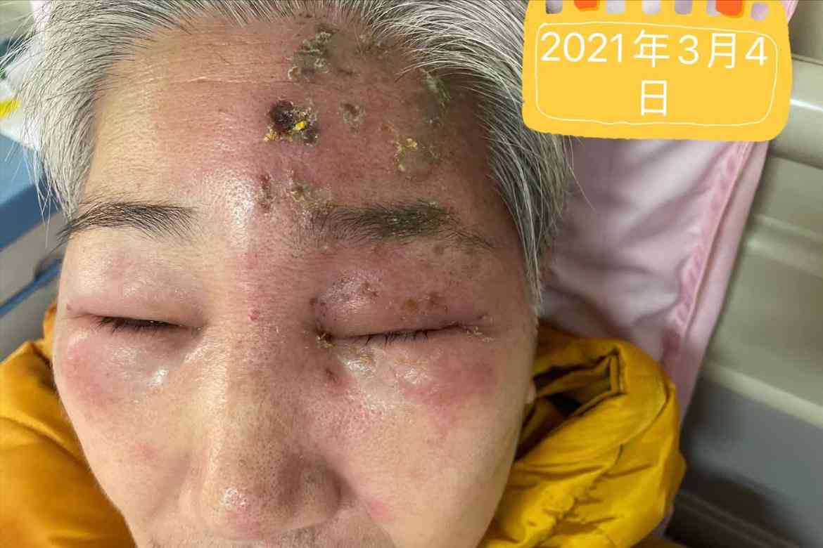 带状疱疹对职场表现及工作效率的潜在影响解析