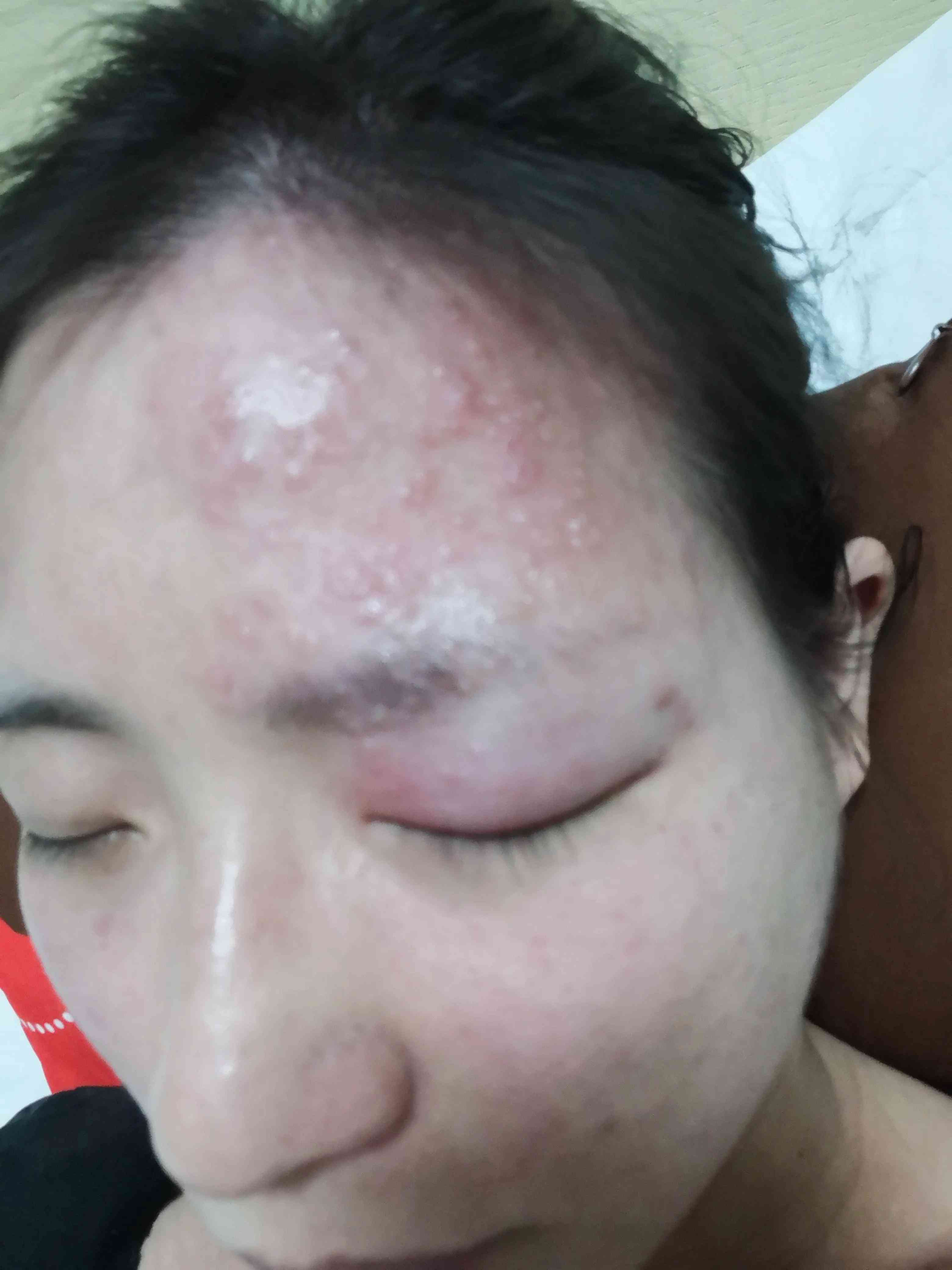 带状疱疹能工作吗需要休息吗：患带状疱疹是否可以上班及休息建议