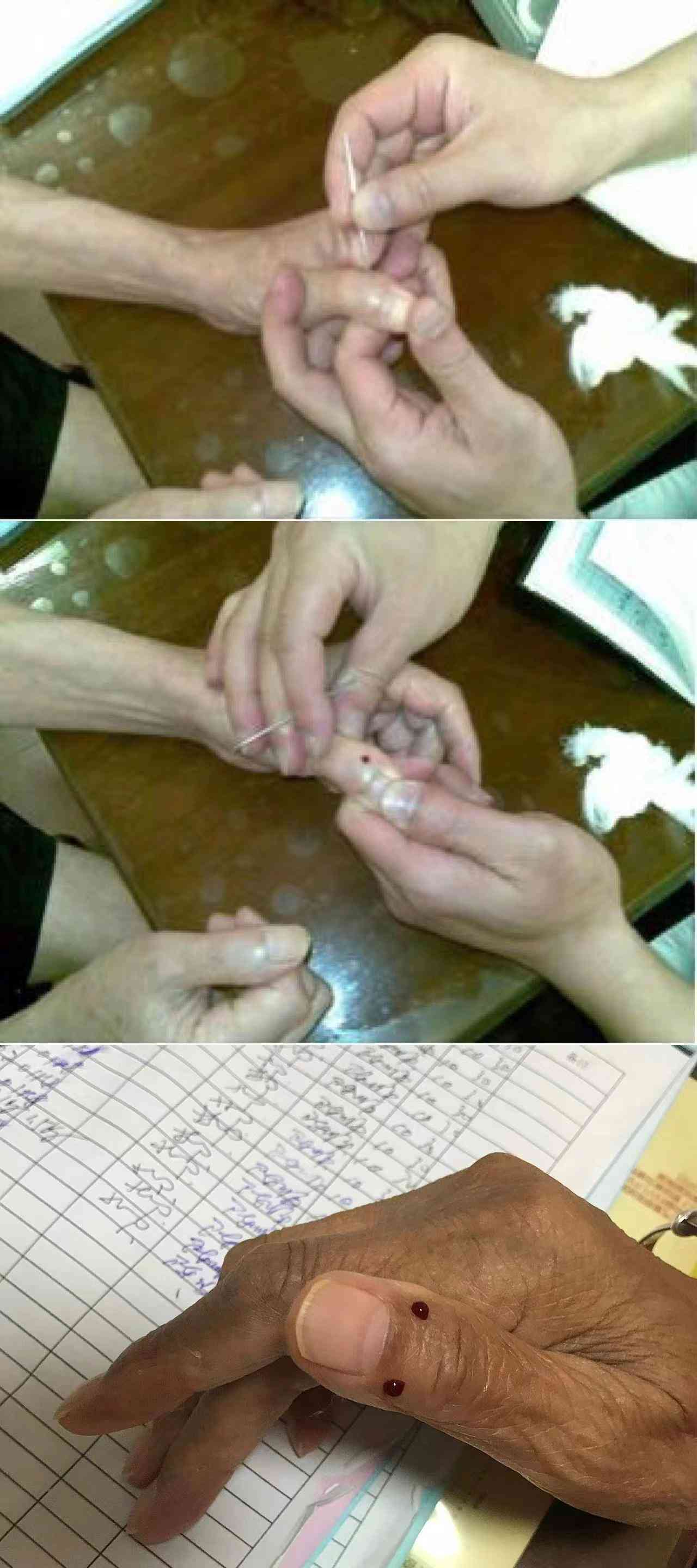 带状疱疹能工作吗需要休息吗：患带状疱疹是否可以上班及休息建议