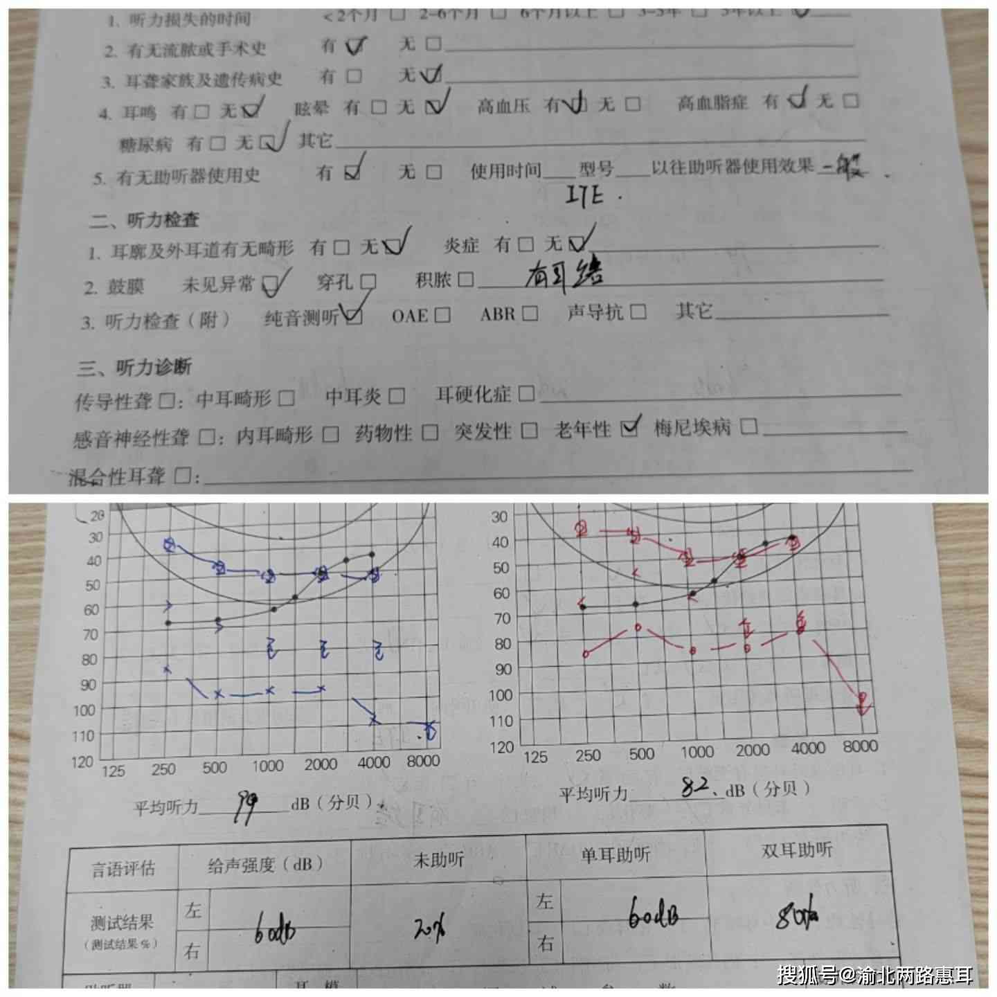 纯音测听报告解读：如何查看与撰写结果分析