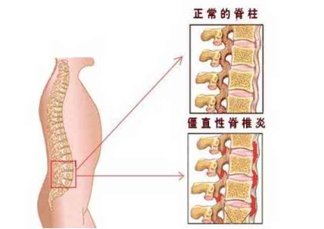 强直性脊柱炎患者工作期间患病，能否依照工伤标准申请赔偿？