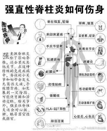 强制性脊柱炎能认定工伤吗