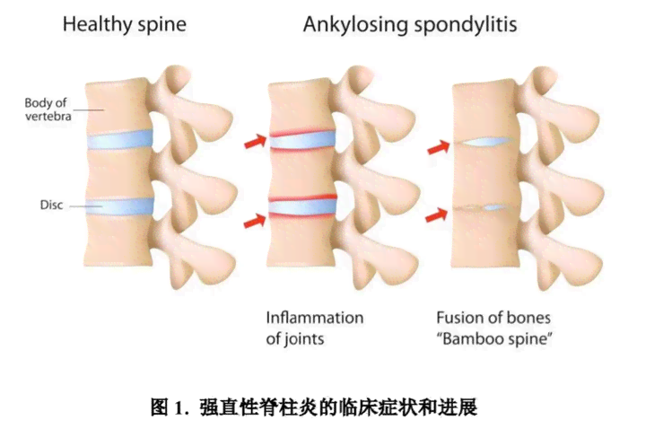 强直性脊柱炎能认定工伤吗