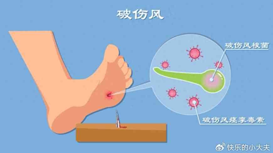得了破伤风可以认定工伤吗怎么赔偿及治愈情况咨询医生