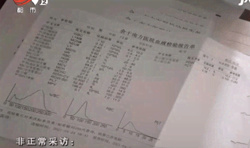 心境障碍是精神病吗：是否需住院、能否遗传、视病情而定及其与遗传的关系