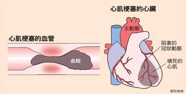 心肌劳损：是否构成疾病诊断及治疗要点