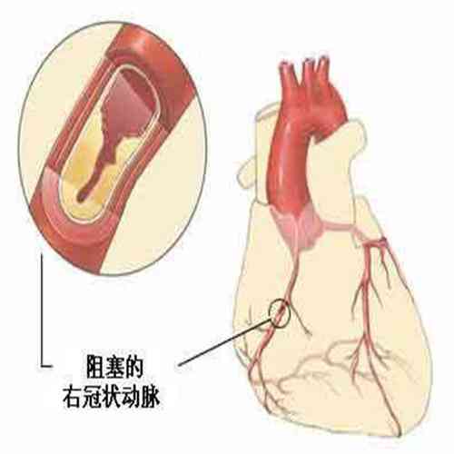 心脏支架能认定工伤吗