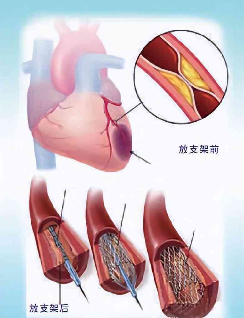 心脏支架能认定工伤吗