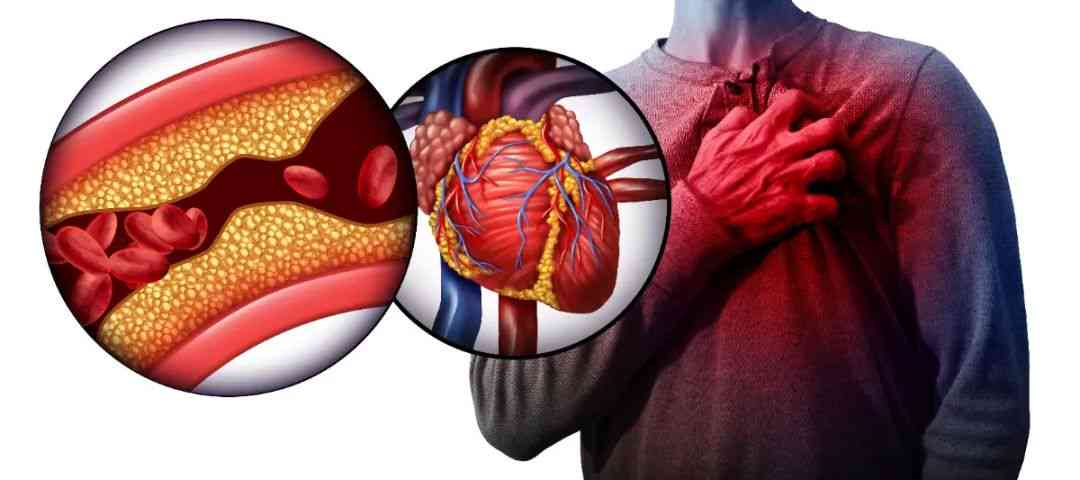 心血管塞算心脏病吗：严重性、治疗与是否属于心梗详解