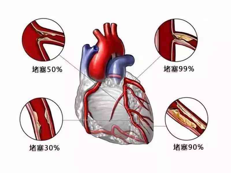 心血管塞算心脏病吗：严重性、治疗与是否属于心梗详解