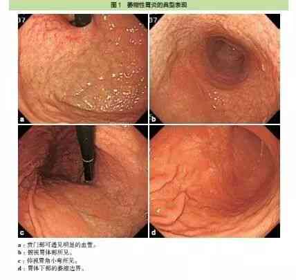 急性胃炎算重病吗：是重大疾病还是急性疾病，严重性分析