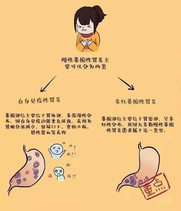 急性胃炎：它是否属于急性疾病及其相关症状、成因与治疗全面解析