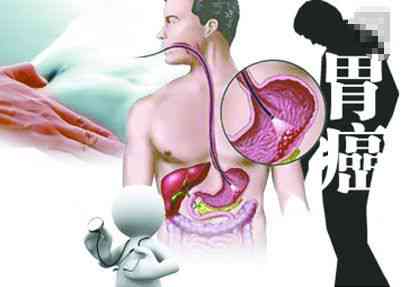 急性胃炎算重病吗：是重大疾病还是急性疾病，严重性解析