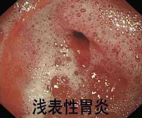急性胃炎算重病吗：是重大疾病还是急性疾病，严重性解析