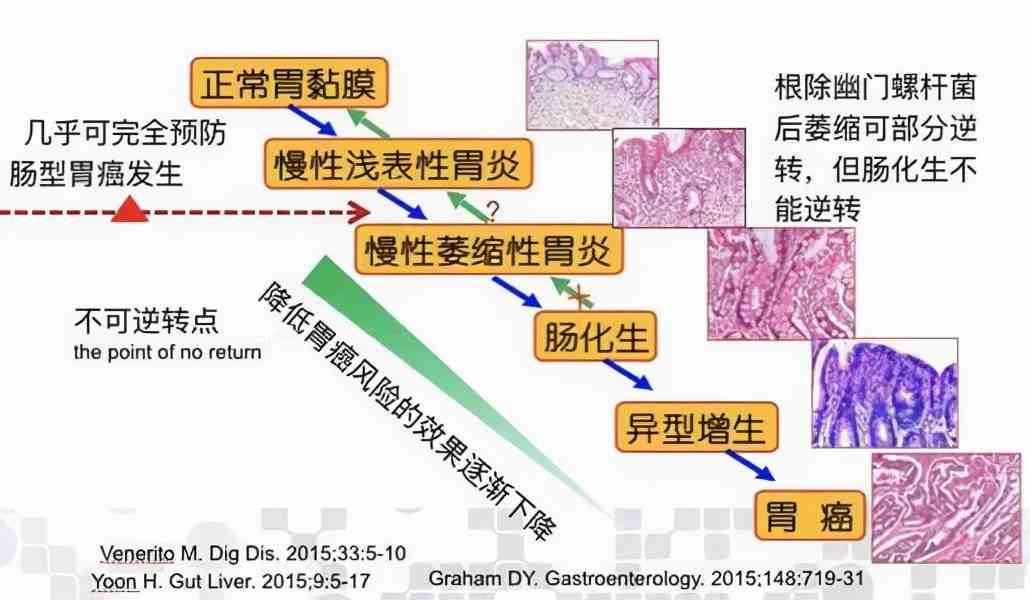 急性胃炎是否归类为重大疾病：探讨其影响与界定