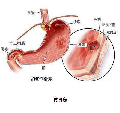 急性胃炎的潜在风险与防治措：了解危害、症状及紧急处理方法