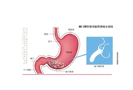 急性胃炎的潜在风险与防治措：了解危害、症状及紧急处理方法