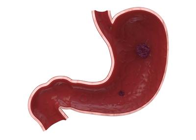 急性胃炎的潜在风险与防治措：了解危害、症状及紧急处理方法