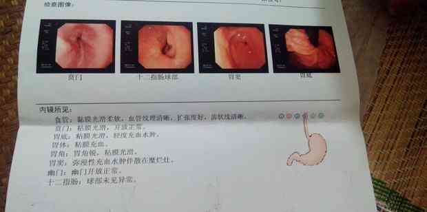 急性胃炎是否属于重症：探讨其严重性与治疗要点
