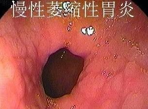 急性胃炎是否属于重症：探讨其严重性与治疗要点